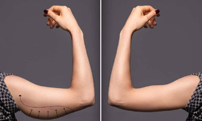 لاغری موضعی بازو با دستگاه